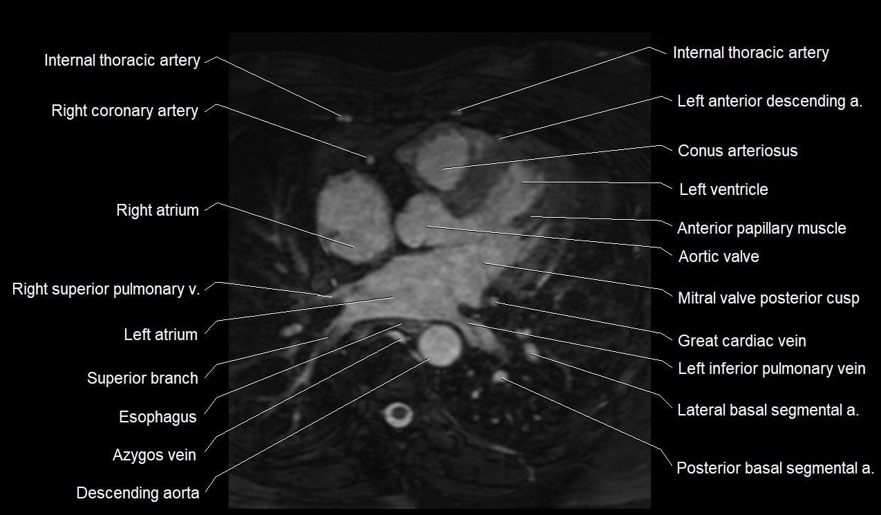 MRI heart coronary arteries and coronary veins anatomy axial image 22.jpg